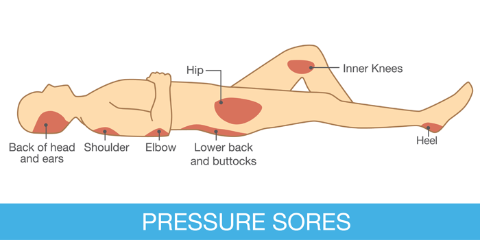 Pressure Sores